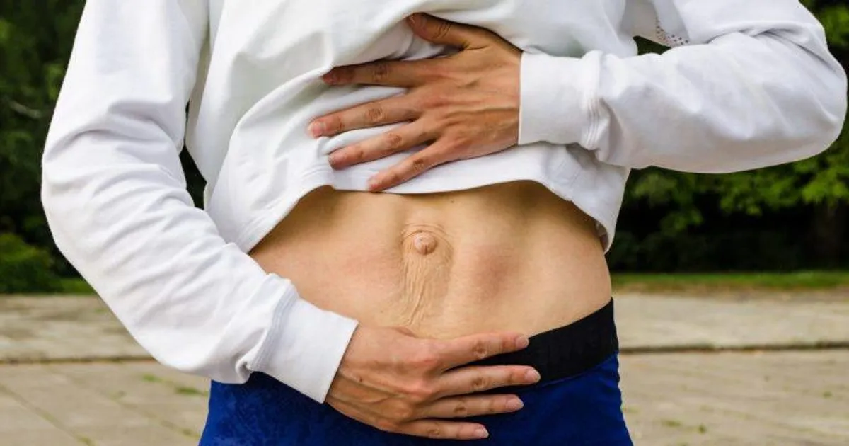 Diástasis Abdominal